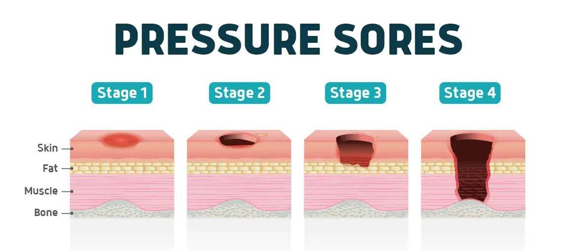 stages of pressure sores